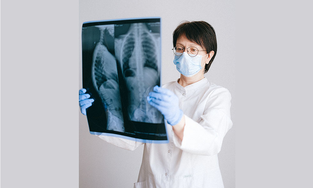 Gravedad en pacientes con fibrosis pulmonar idiopática es muy alta si se contagian de Covid-19