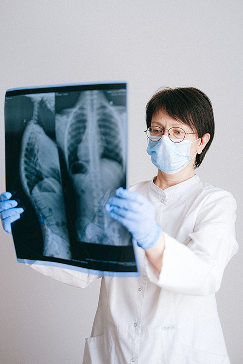 Gravedad en pacientes con fibrosis pulmonar idiopática es muy alta si se contagian de Covid-19